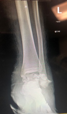 Addressing Talar Avascular Necrosis With A Total Talar Implant